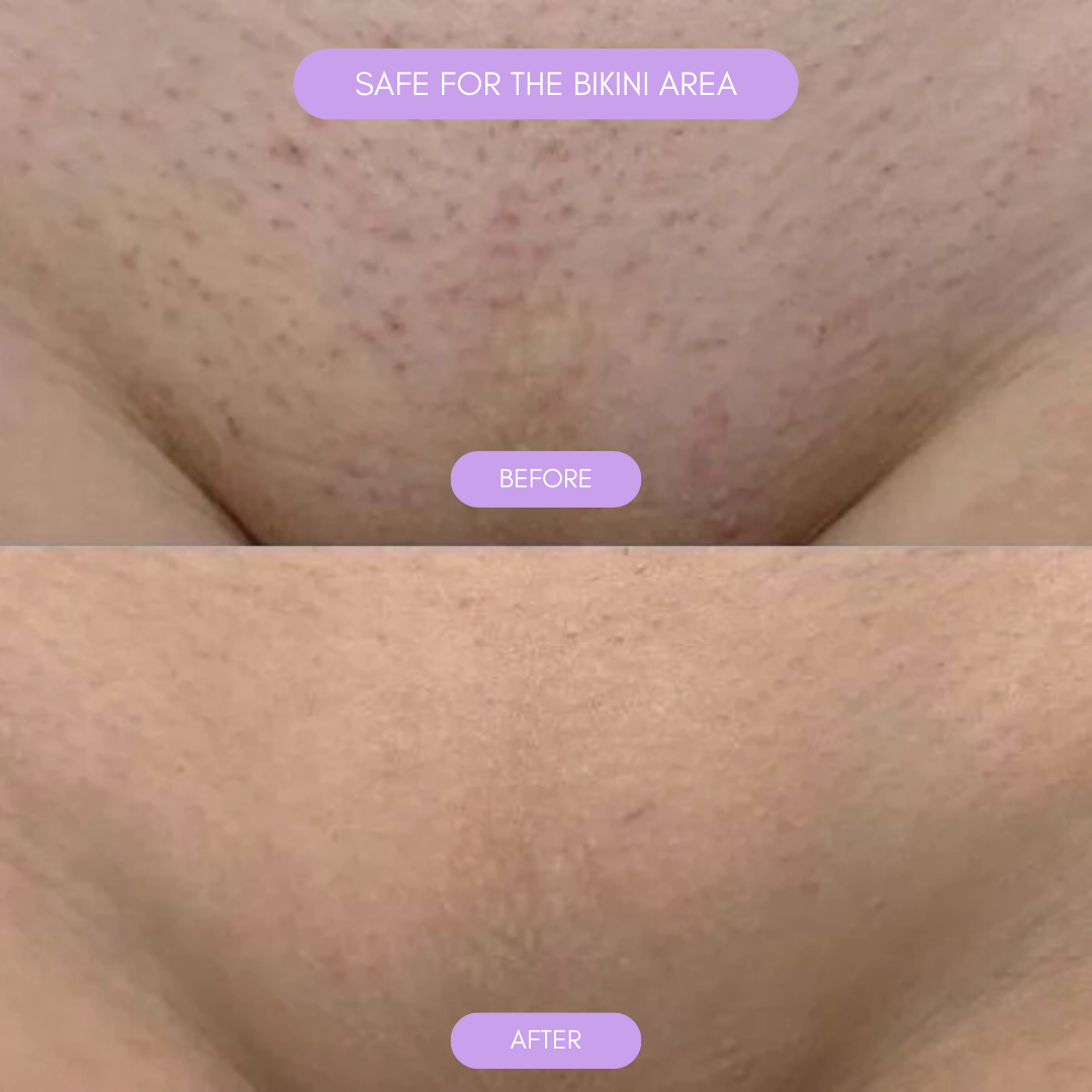 Hair Removal Device for Smooth Skin Kalsten