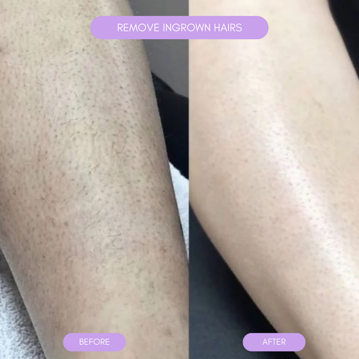 Hair Removal Device for Smooth Skin Kalsten