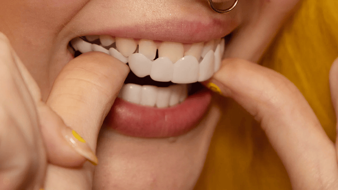 Kalsten | Instant Smile Transformation with Snap on Smile Veneers