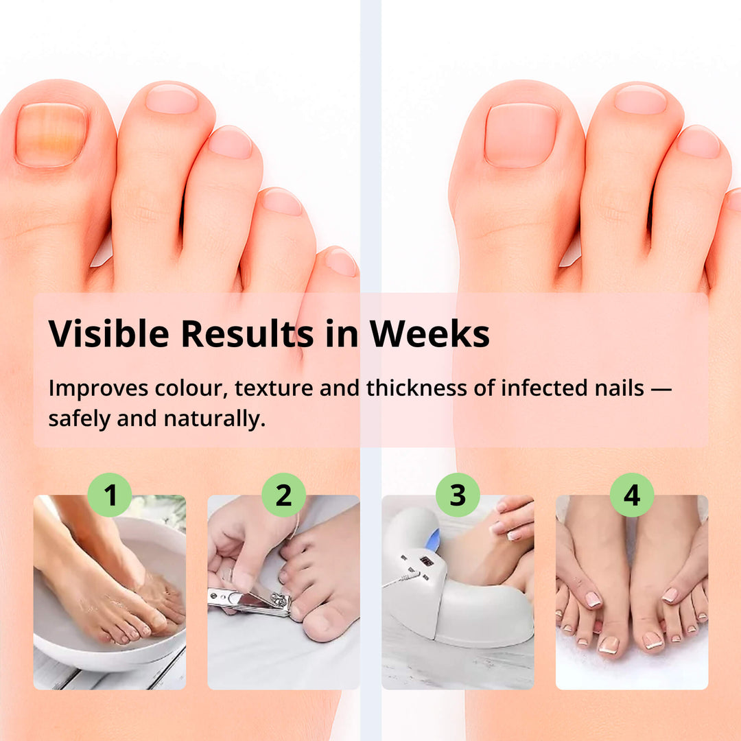 Kalsten | Laser Nail Fungus Removal Device | Advanced Home Treatment with Red & Blue Light for Healthy Nails