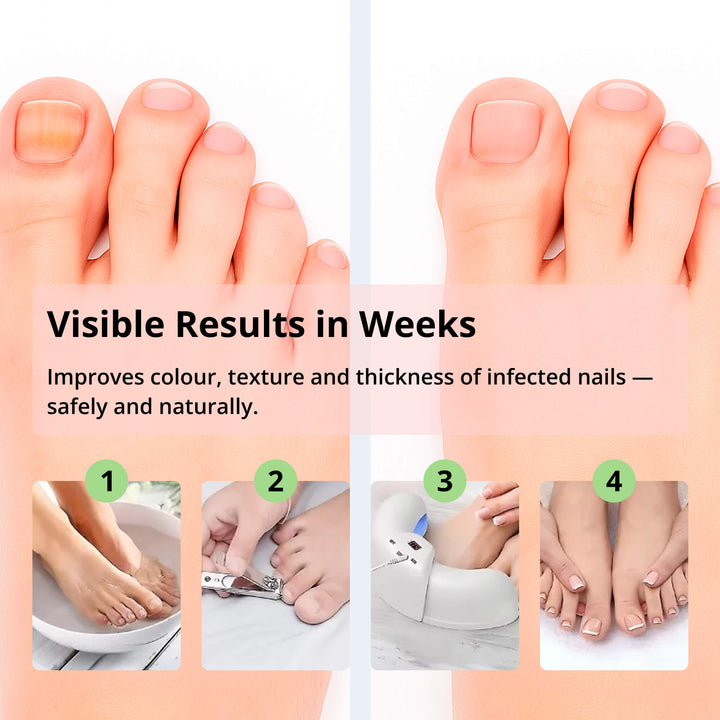 Kalsten | Laser Nail Fungus Removal Device | Advanced Home Treatment with Red & Blue Light for Healthy Nails