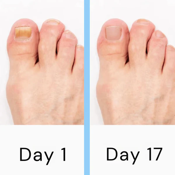 Kalsten | Nail Laser Fungus Device
